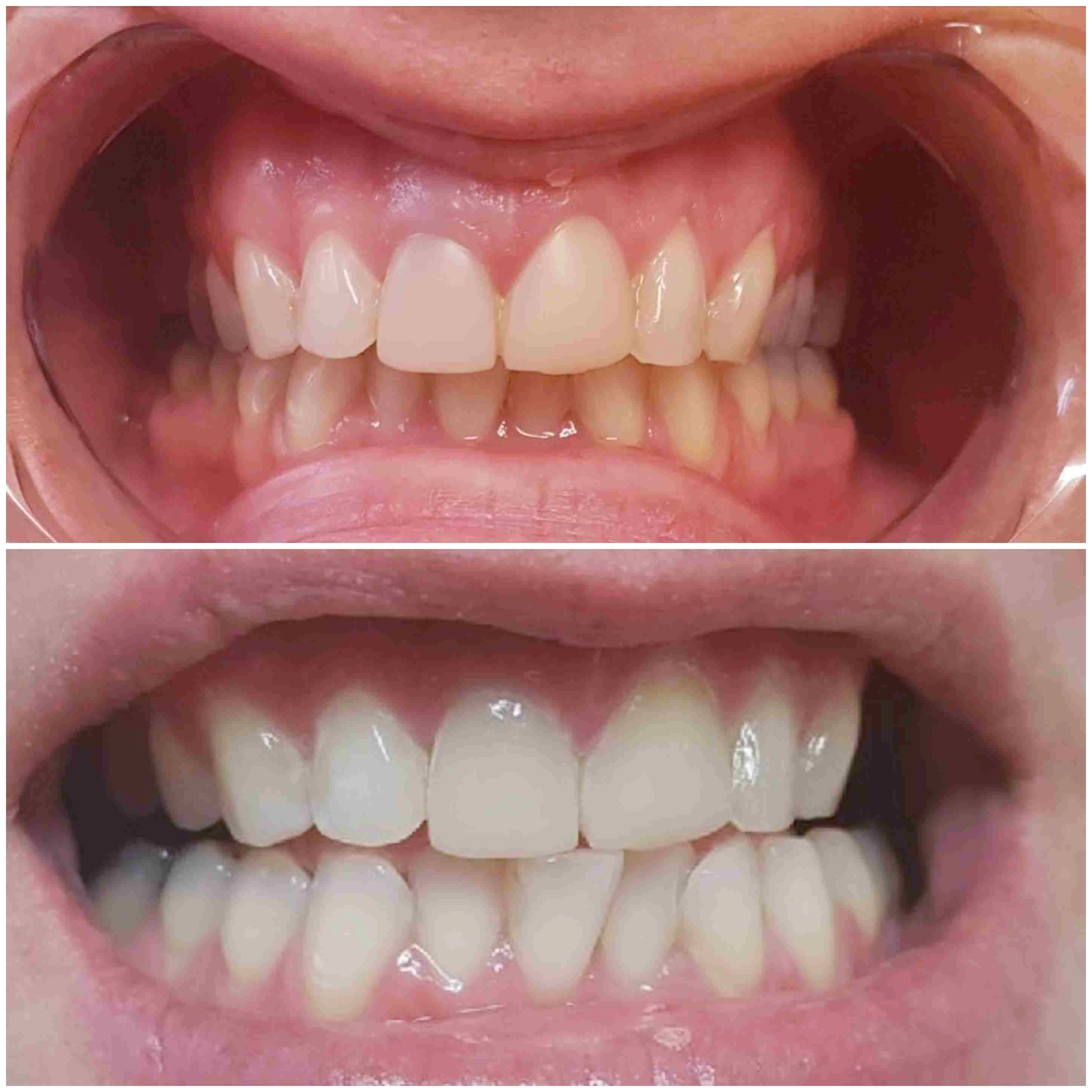 Teeth whitening before and after: yellowed enamel above, markedly whiter enamel below