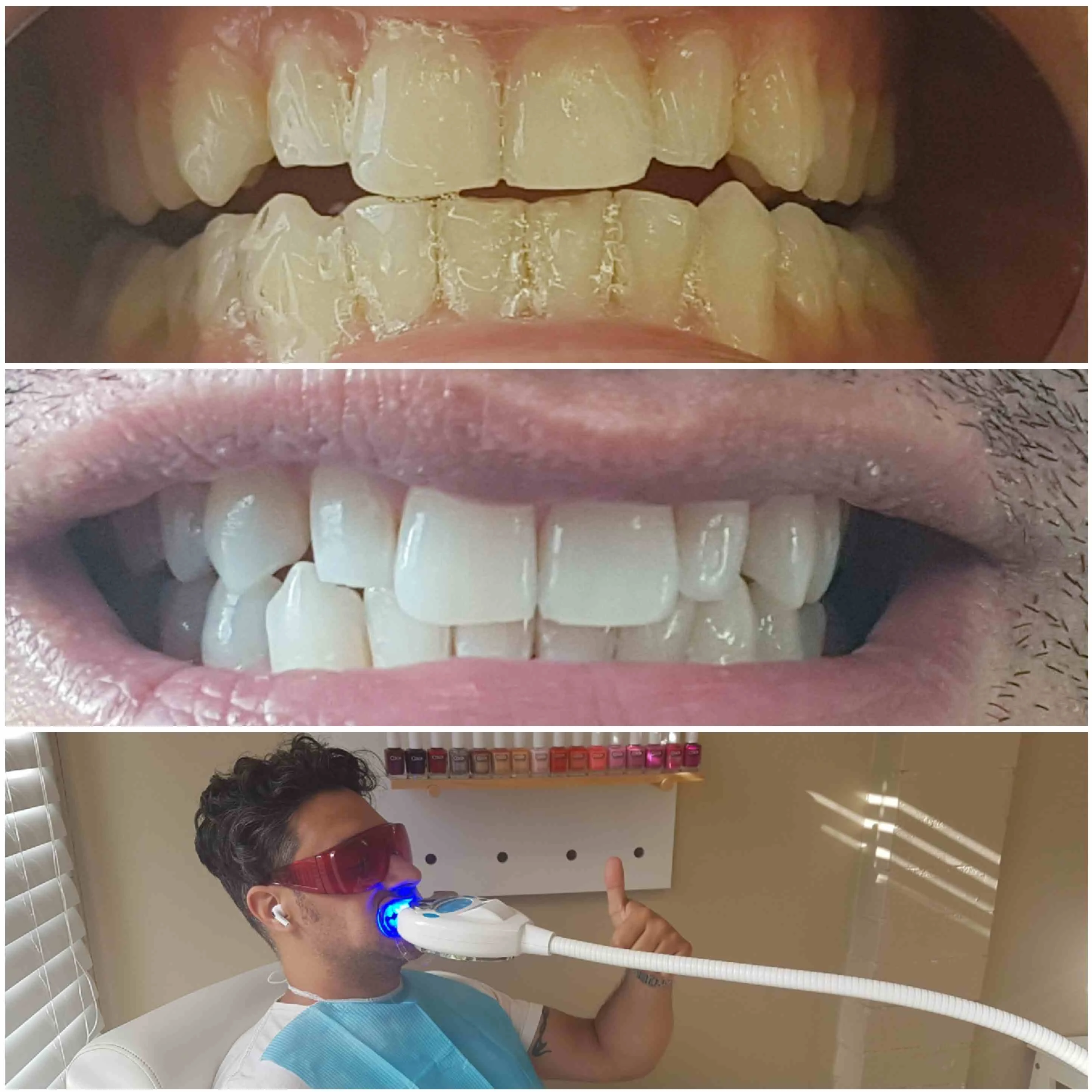 Teeth whitening in progress: client reclined in the studio under a blue LED whitening lamp