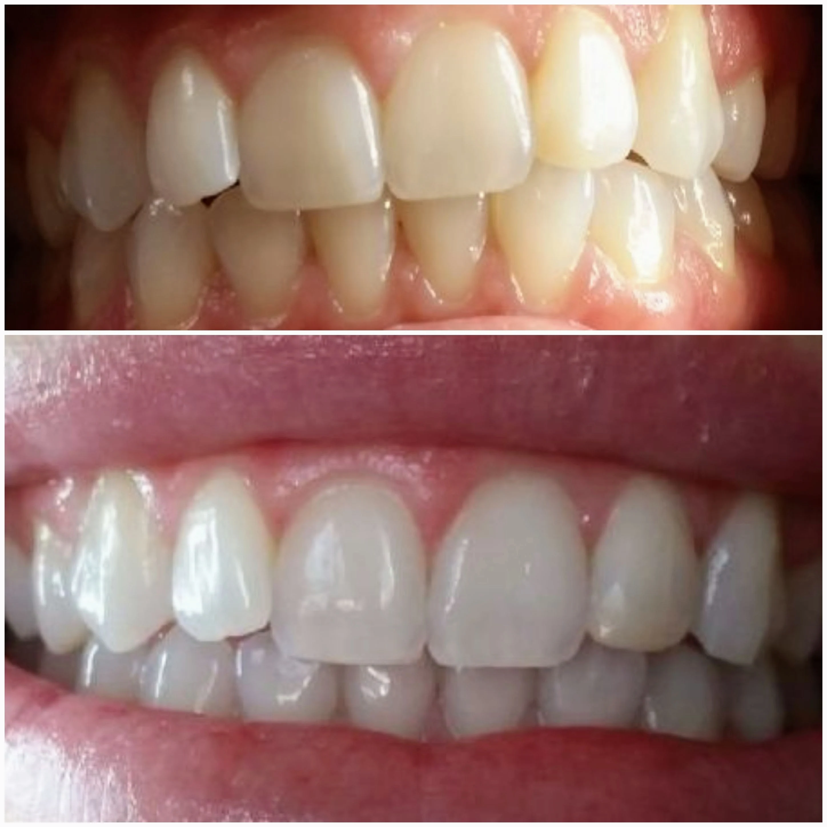 Teeth whitening before and after on a third client