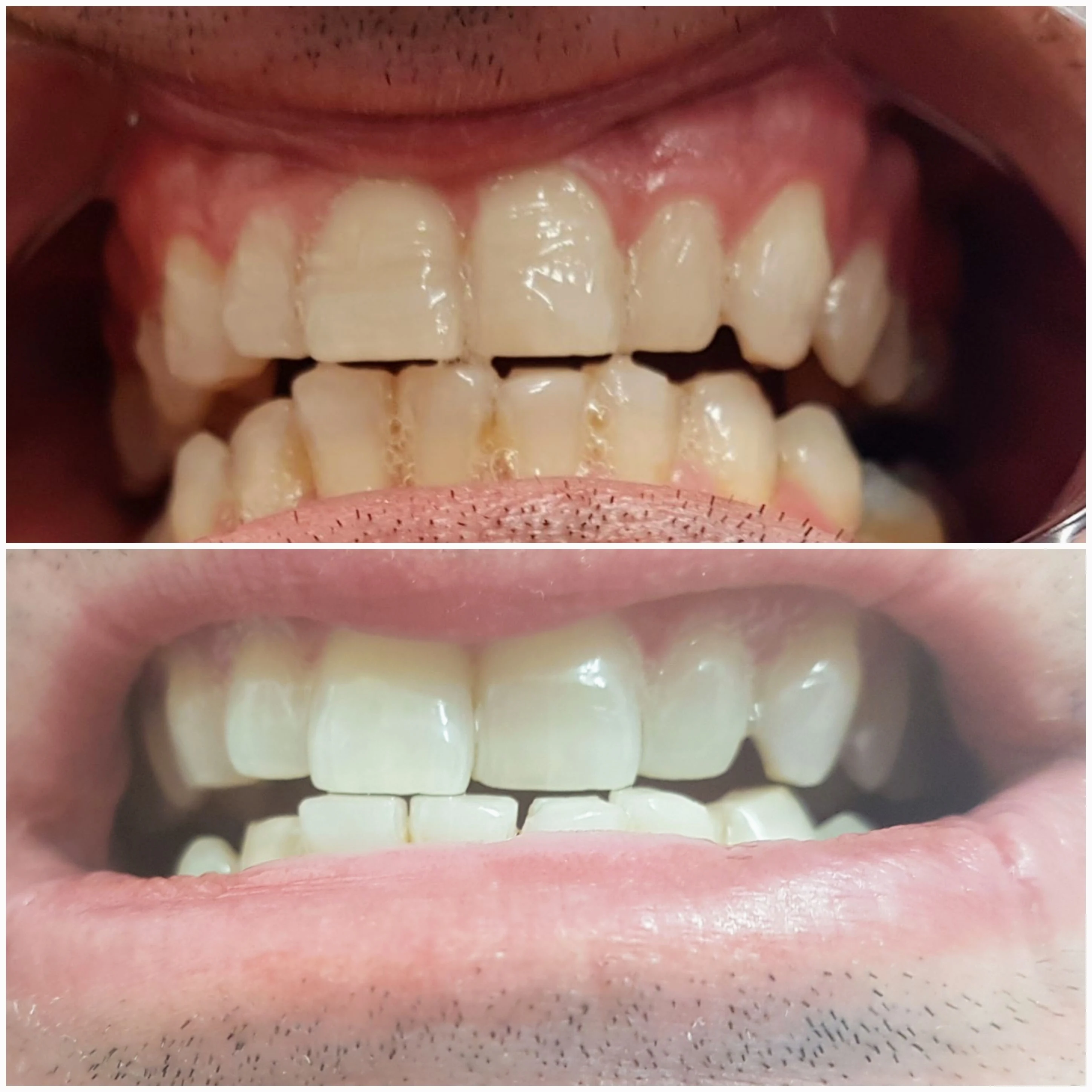 Teeth whitening before and after on a second client
